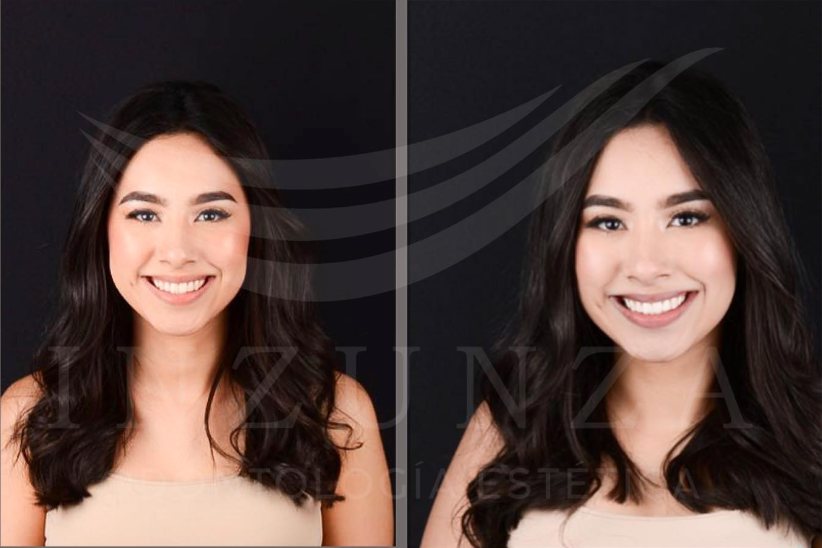 Blanqueamiento Dental en Culiacán