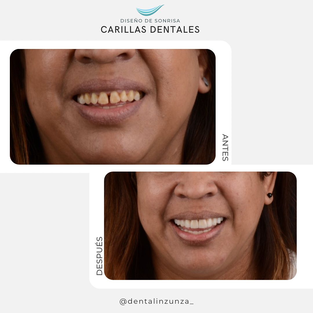 Carillas de Porcelana