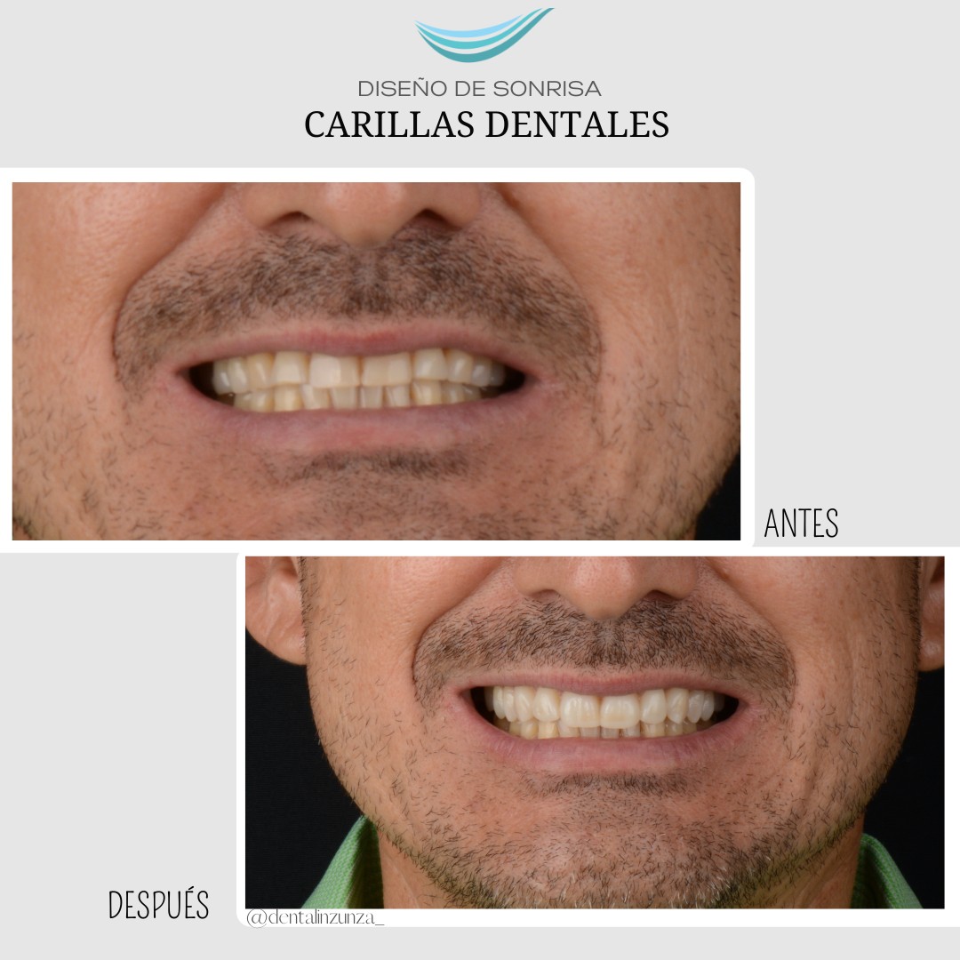 Blanqueamiento Láser